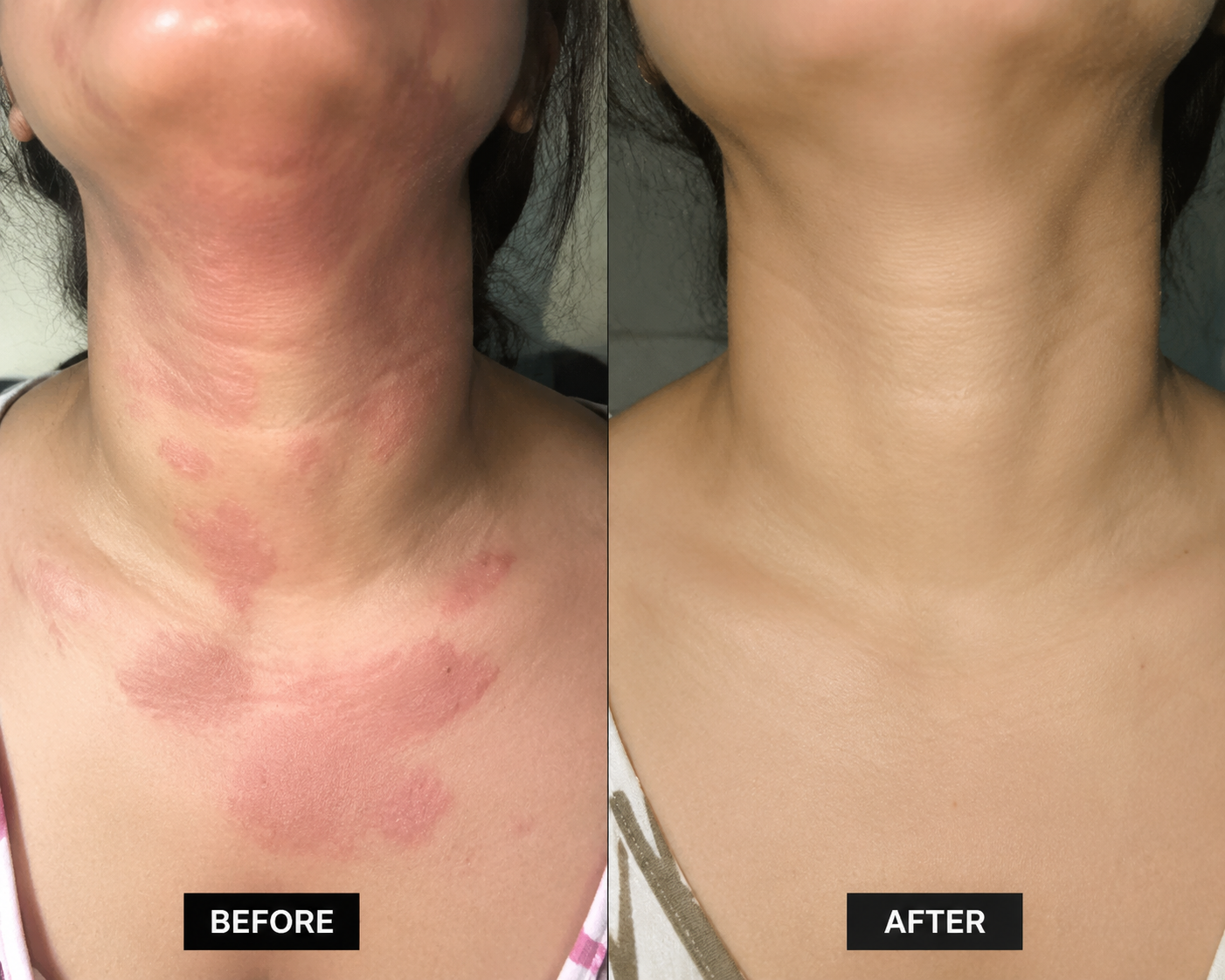 Urticaria — before and after